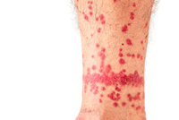flea bite