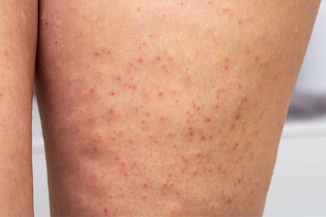 Folliculitis