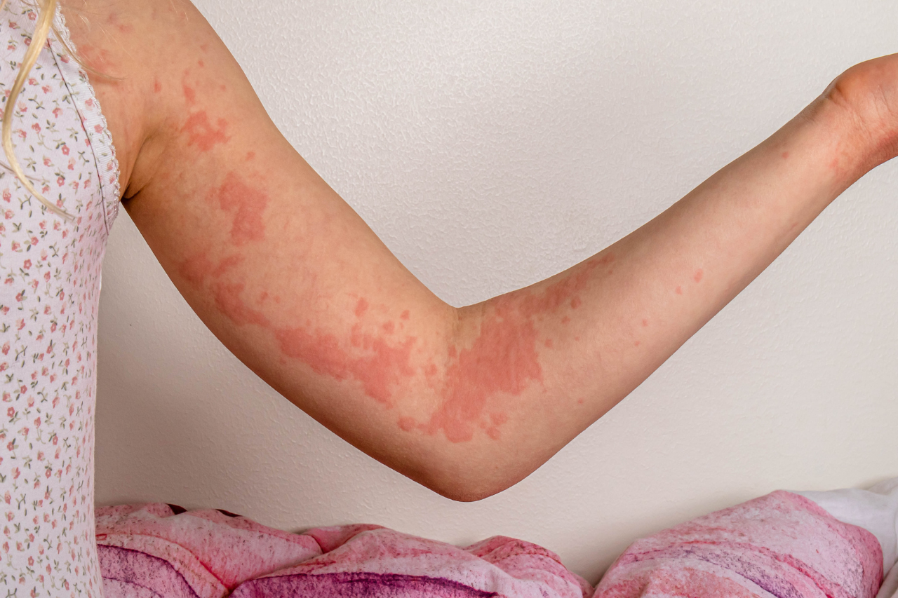 hives