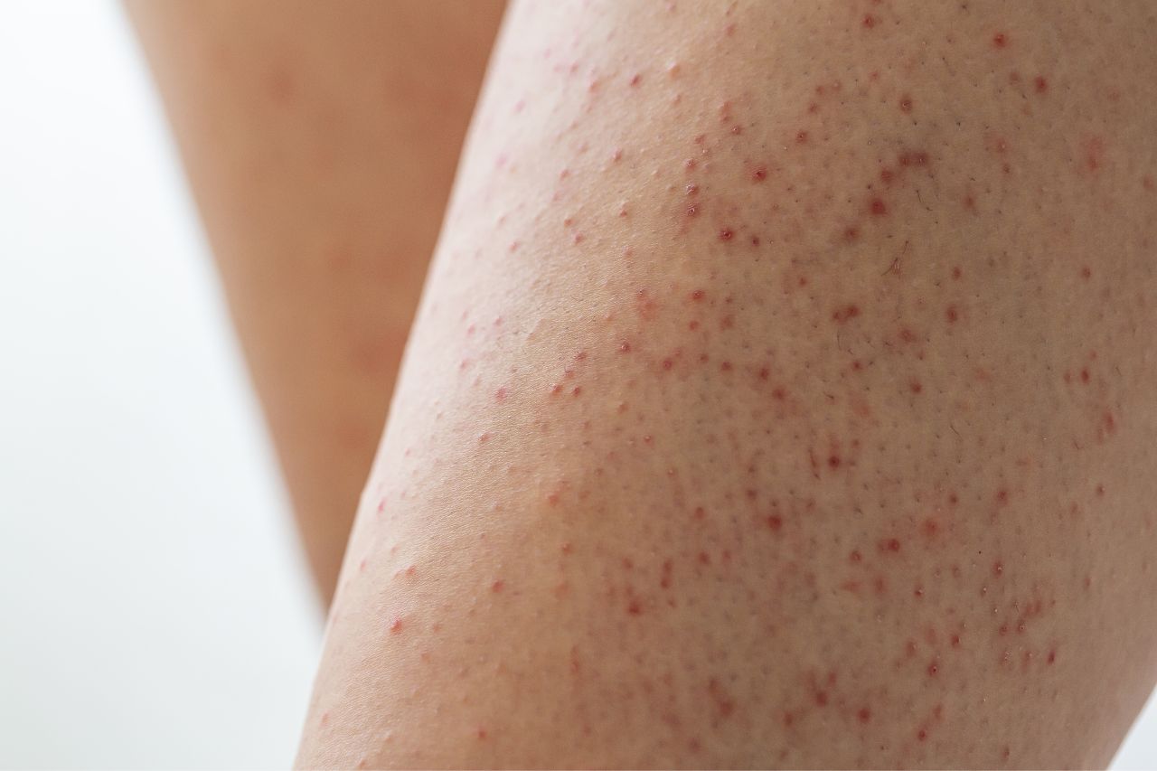 keratosis pilaris