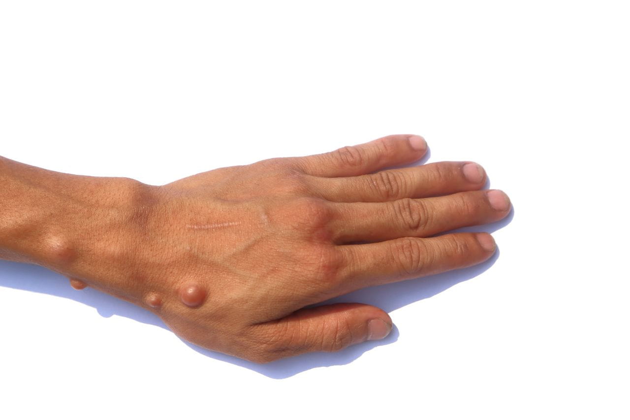 neurofibromatosis