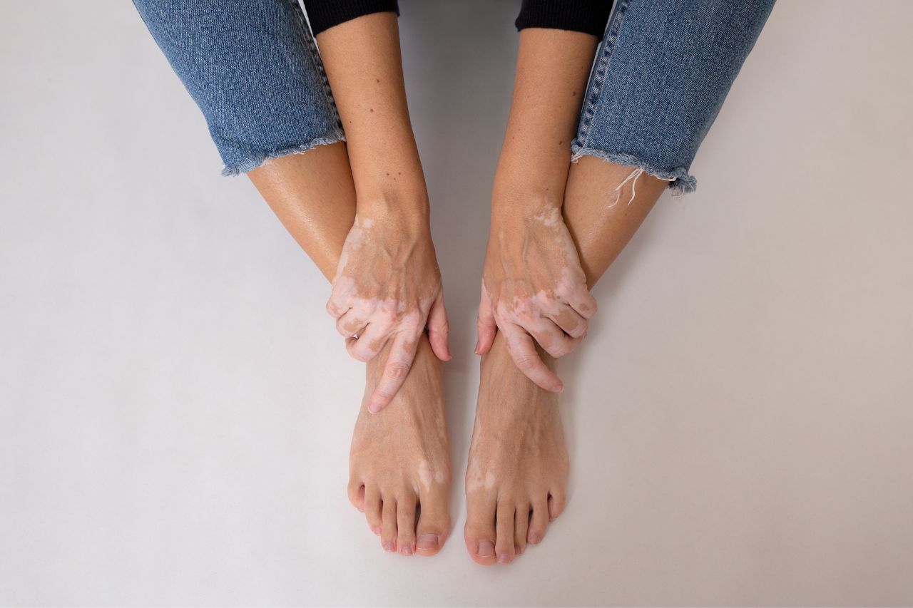 Tinea Versicolor or Pityriasis Versicolor Skin-Causes-Diagnosis-Best treatment options-Top Homeopathic doctor in Pakistan-Dr Qaisar Ahmed-Al Haytham clinic- Risalpur