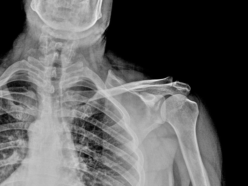 xray