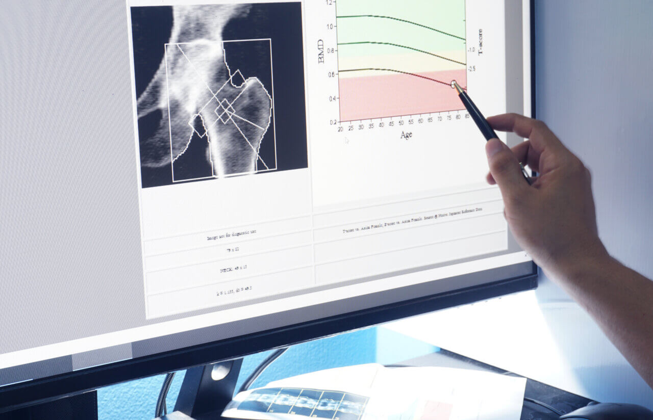 low bone mass density scan