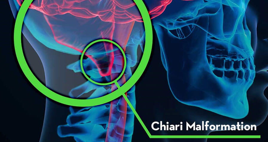 chiari-malformation