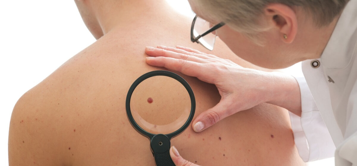 skin cancer screening