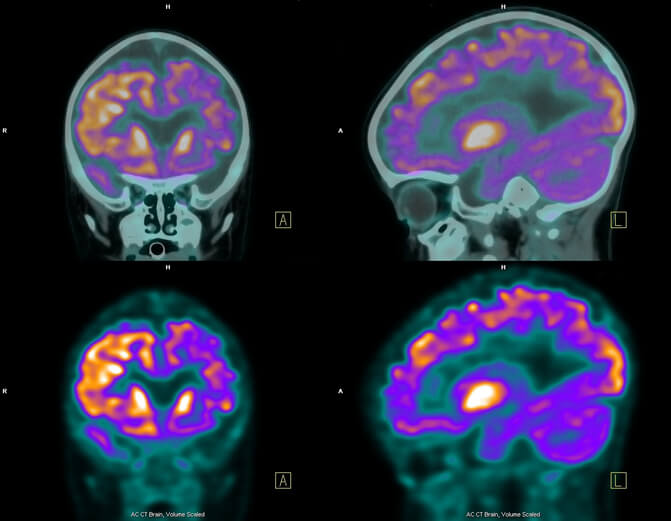 what is the difference between a seizure and epilepsy