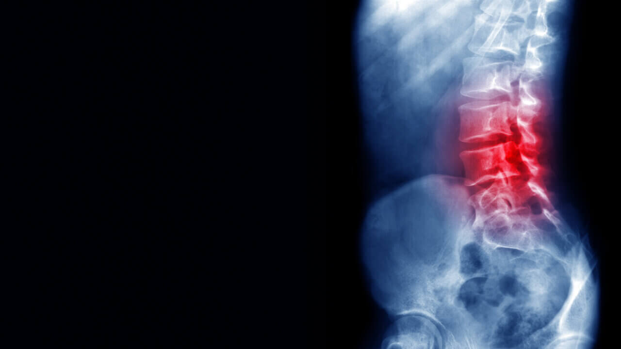 herniated disc causing back pain