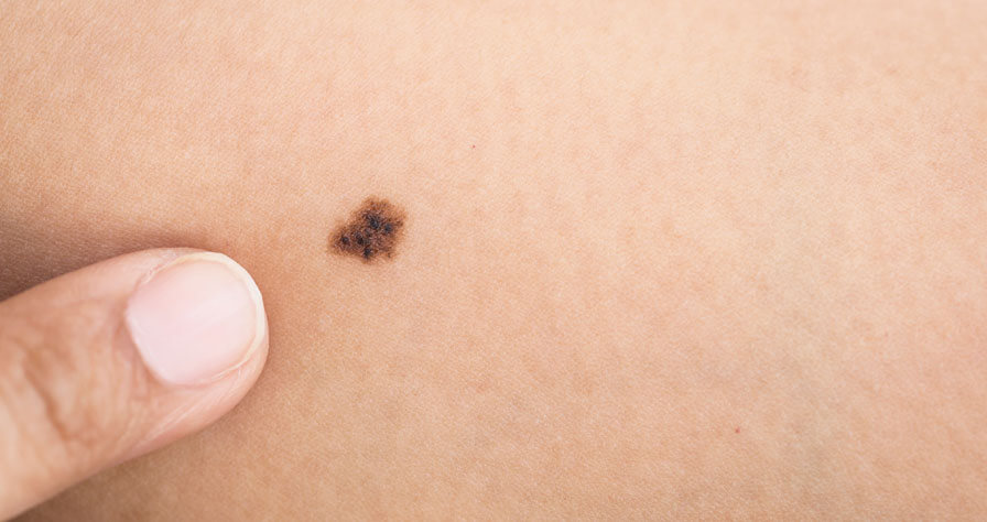 Signs of Cancerous Moles - Baptist Health